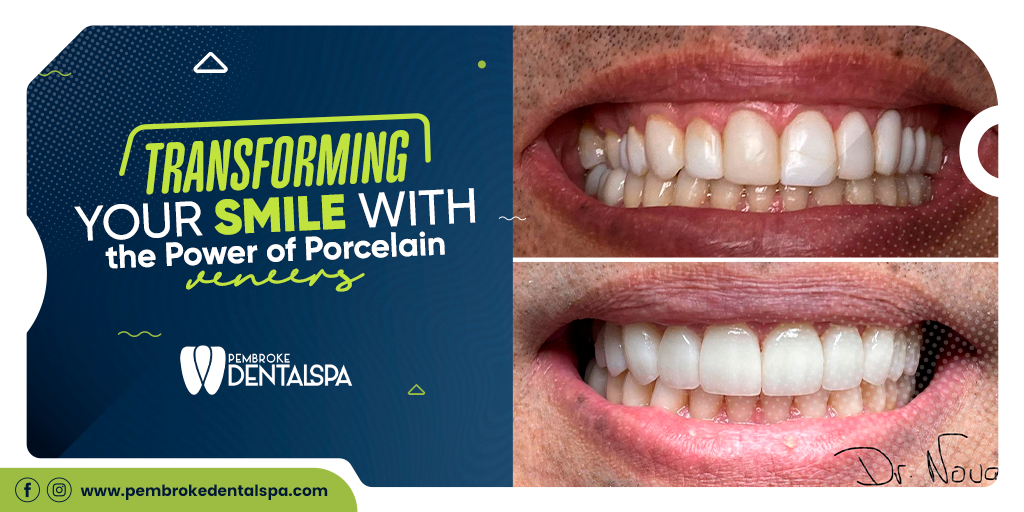 Transforming Your Smile With the Power of Porcelain Veneer