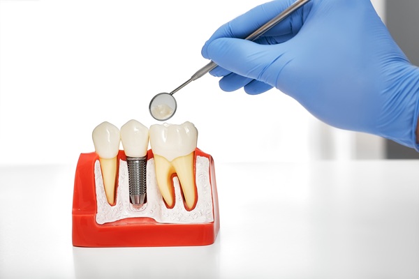 Making Your Implant Crowns Last