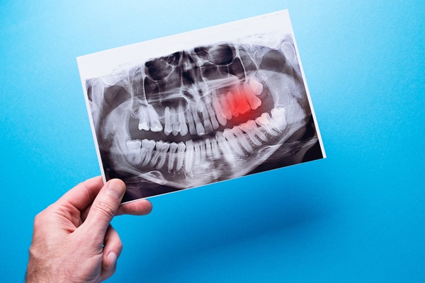What Can Happen If Wisdom Teeth Are Not Removed?